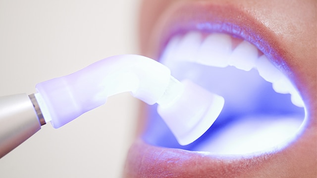 Hoe kies je de tandbleekbehandeling die het meest geschikt is voor jou?