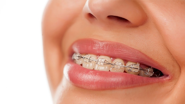 Hoe kun je vlekken op je tanden voorkomen als je een beugel draagt?