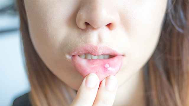 Mondirritaties en -aandoeningen