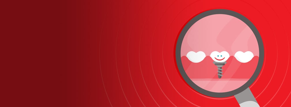 tandimplantaat onder het tandvlees tandimplantaat onder het tandvlees