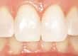 ToothWhitening